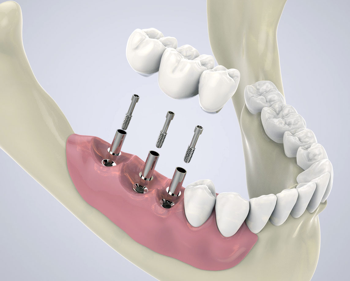 Impianto Dentale La Casa Del Sorriso